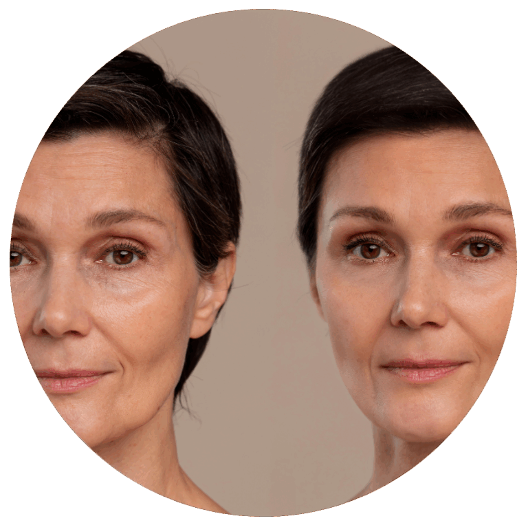 morpheus8 arckezelés Budapest előtte utána